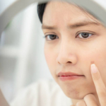 シミじゃなかった。肝斑ケア。